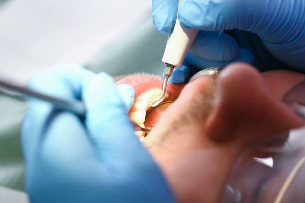 Best Broken or Chipped Tooth Repair in Hanley Hills, MO