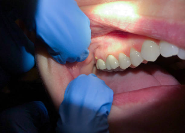 Best Dental Abscess Treatment in Hanley Hills, MO